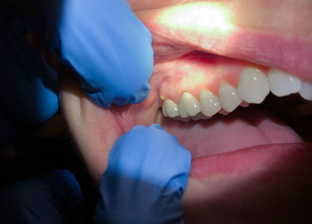 Best Emergency Treatment for Dental Infections or Abscesses in Newton, MS